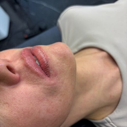 Alma Lipsology™️ Multi-Layer Cannula Technique