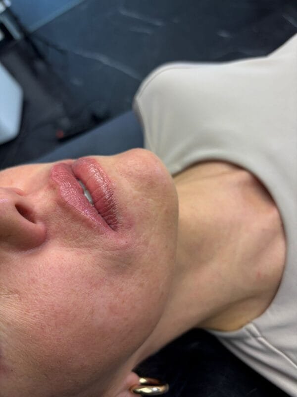 Alma Lipsology™️ Multi-Layer Cannula Technique